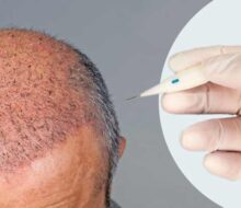 DHI Saç Ekimi; Nasıl Yapılır, Avantajları, Yaptıranlar ve Yorumları