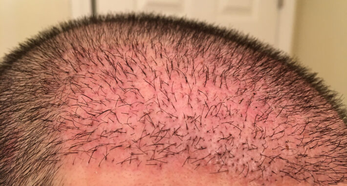 Saç Ekimi Sonrası Kızarıklık Sorunu