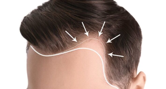 Alın Bölgesinde, Şakaklarda ve Saç Çizgisinde Gerileme ve Saç Dökülmesi