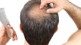 Aşırı Saç Dökülmesi ve Sebepleri